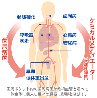 最新歯周病学 大阪市旭区の薬で治す歯周病治療（歯周内科）｜倉松歯科医院